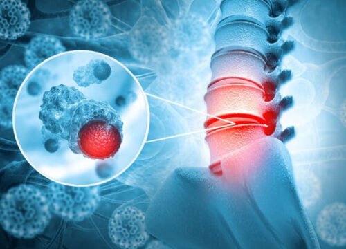 Sarcomas are rare cancers that start in the bones